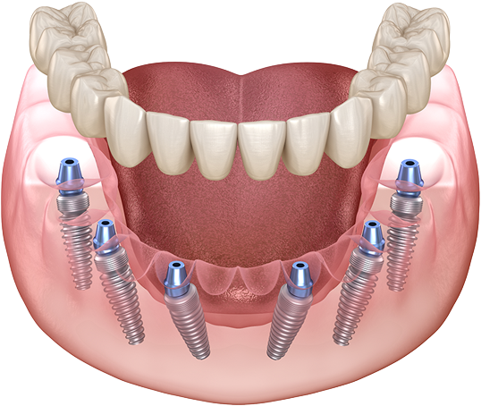임플란트 틀니 이미지
